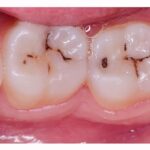 How to Prevent Tooth Decay: Tips for Healthy Teeth