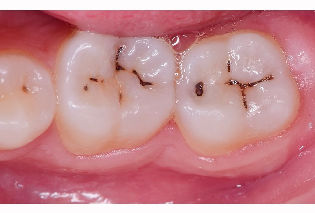 How to Prevent Tooth Decay: Tips for Healthy Teeth